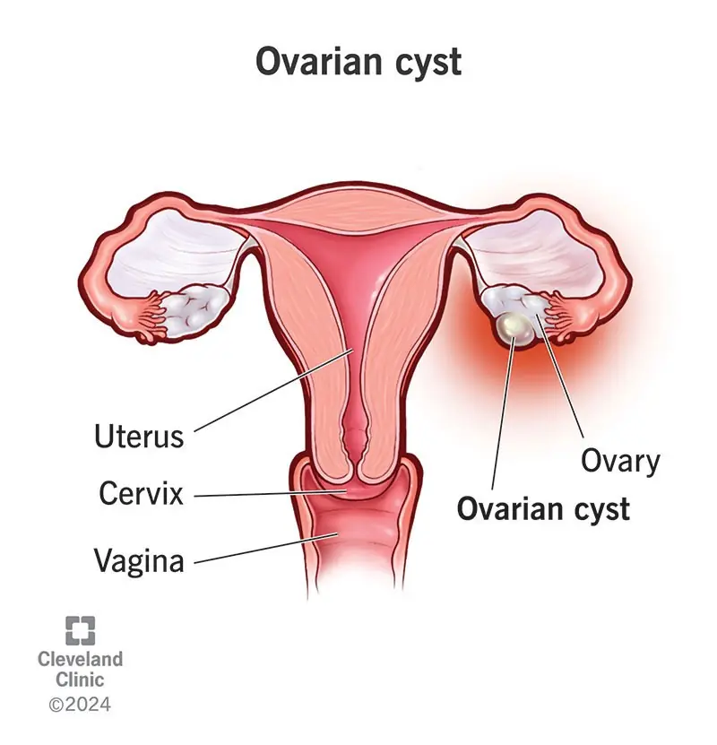 Ovarian Cyst Treatment in Ghaziabad