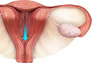 Menstrual Disorder Treatment in Ghaziabad