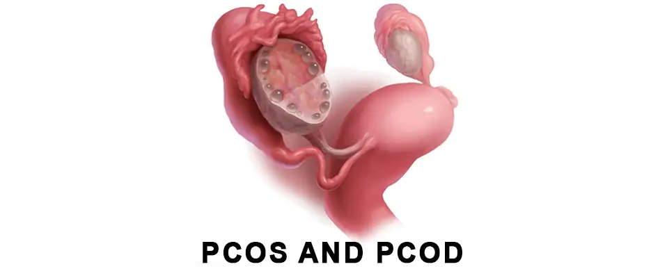 PCOS & PCOD Treatment in Ghaziabad